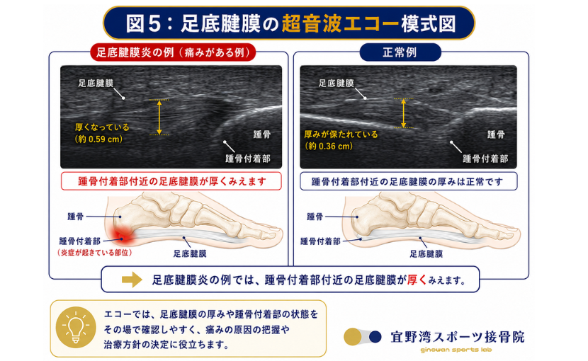 （図5：足底腱膜の超音波エコー模式図。正常例と痛みがある例を並べ、足底腱膜の厚みや踵骨付着部の位置が分かるように示した図。専門的すぎない模式図で、患者さんにも理解しやすい構成）