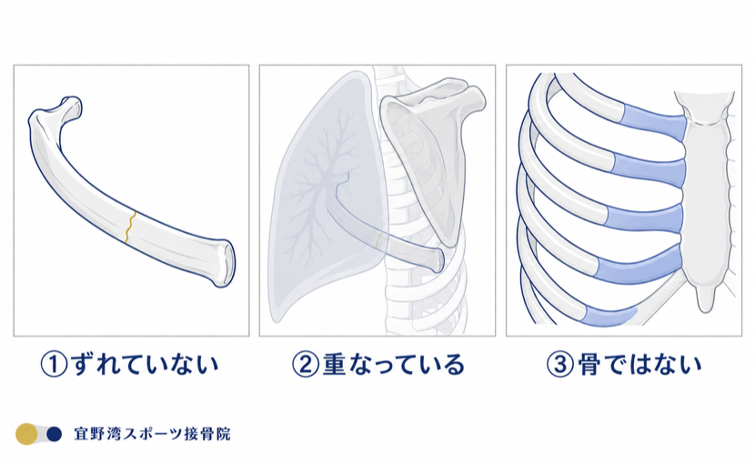 レントゲンに写りにくい3つのパターン：①骨がずれていない骨折、②肺や肩甲骨と重なる肋骨、③骨ではない肋軟骨
