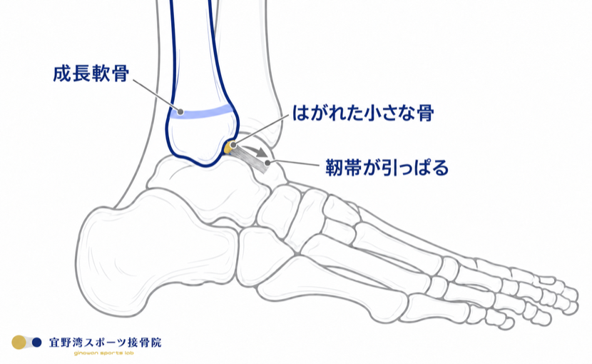 子どもの足首を外側から見た図。腓骨の成長軟骨と、靭帯に引っぱられてはがれた小さな骨片（裂離骨折）