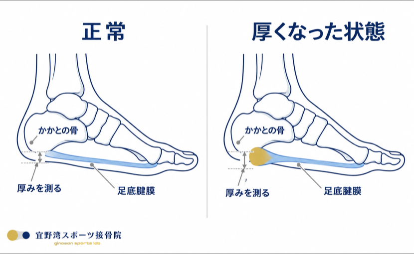 足底腱膜の厚みの比較。左が正常、右はかかと側が厚くなった状態で、それぞれの厚みを矢印で示している