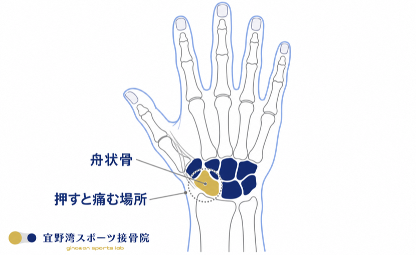 右手を手の甲側から見た図。母指側の手根骨にある舟状骨と、押すと痛む場所（解剖学的嗅ぎタバコ入れ）の位置