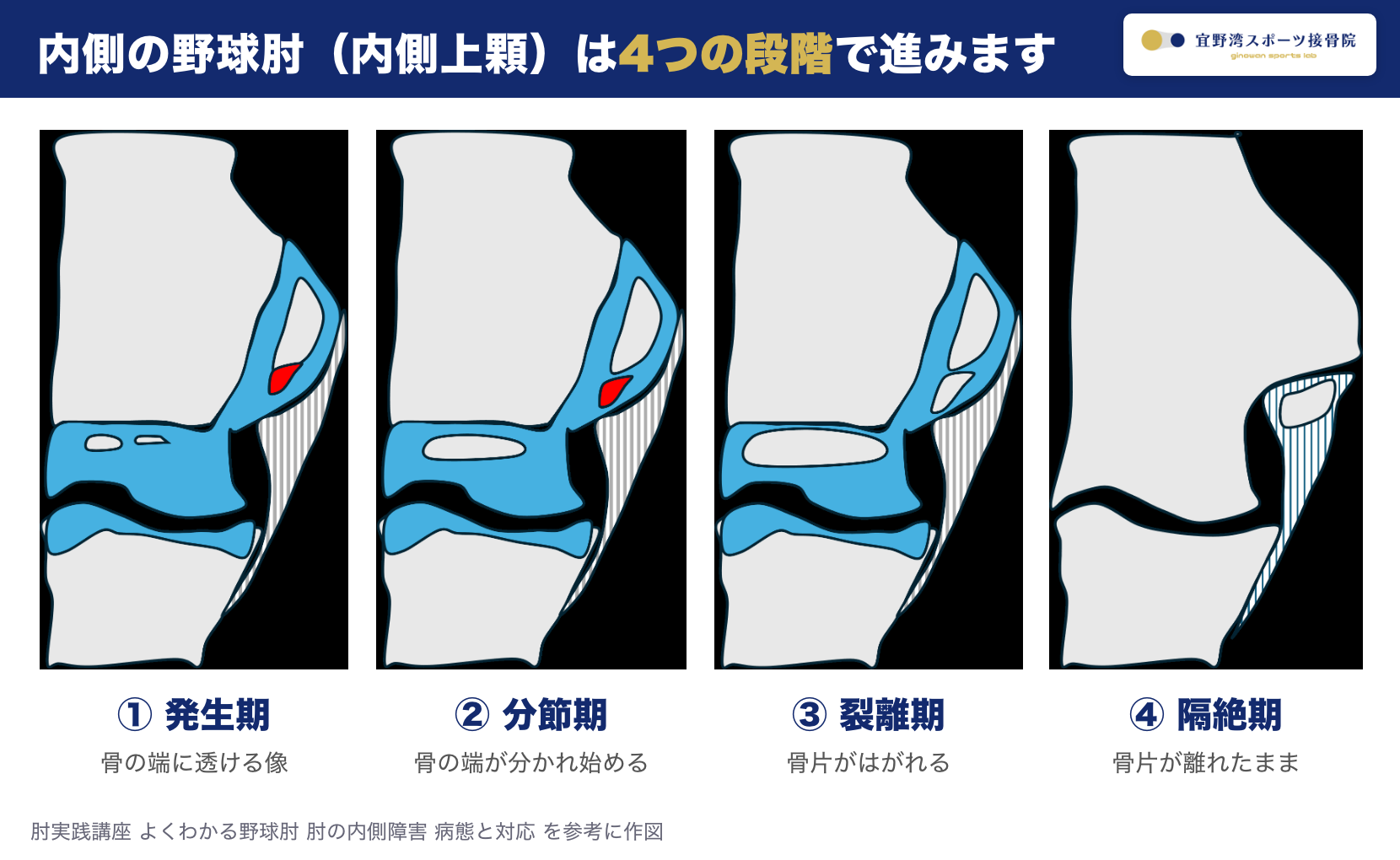 内側の野球肘（内側上顆の障害）の4つの段階 発生期 分節期 裂離期 隔絶期