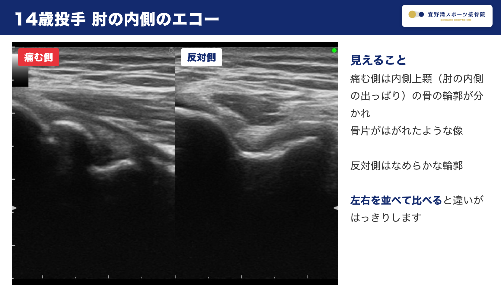 14歳投手の肘の内側のエコー 痛む側は内側上顆の骨片がはがれた像 反対側はなめらか