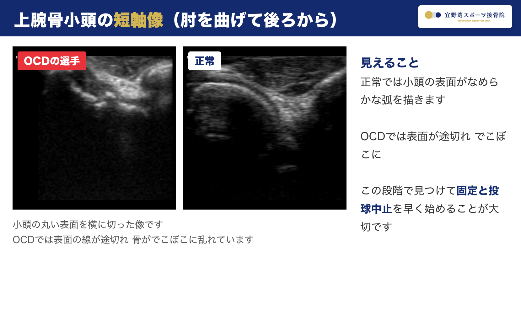 上腕骨小頭の短軸像 OCDの選手は表面が途切れでこぼこ 正常はなめらかな弧