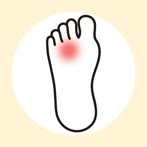 モートン病（モートン神経腫）
