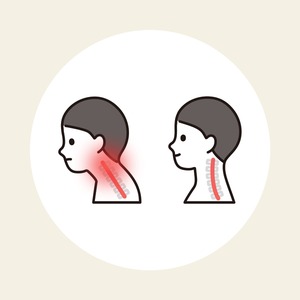 首の痛み（頸部痛）